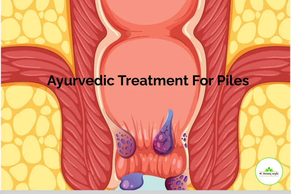 Ayurvedic Treatment For Piles