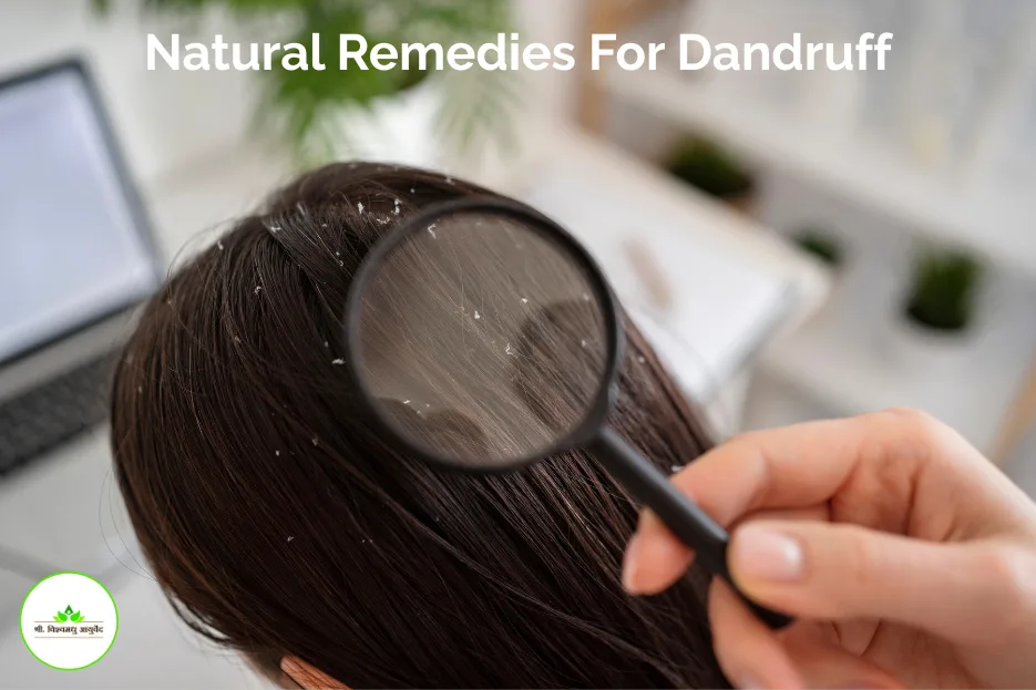 Natural Remedies For Dandruff